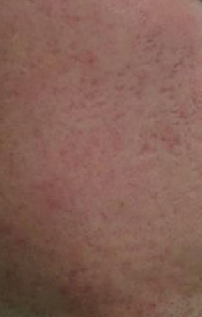 huidverbetering_micro_needling_acne_na