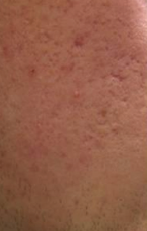 huidverbetering_micro_needling_acne_voor